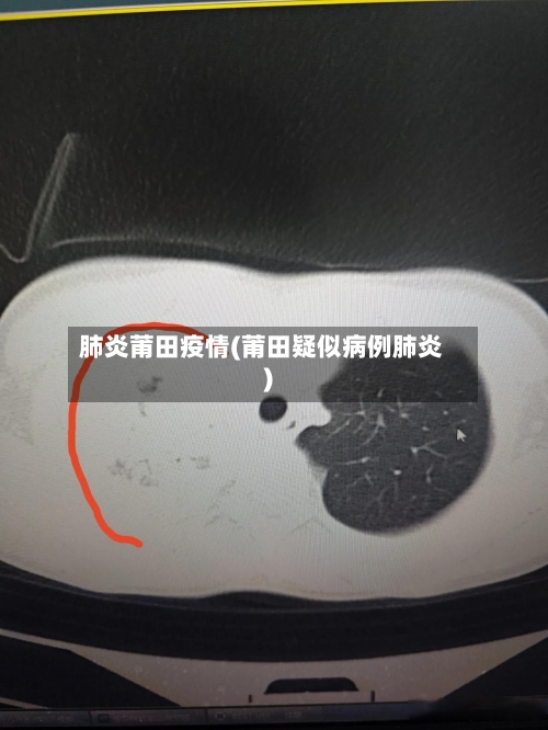 肺炎莆田疫情(莆田疑似病例肺炎)-第1张图片